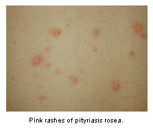 Pink rashes of pityriasis rosea.