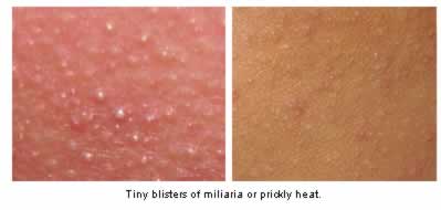Tiny blisters of miliaria or prickly heat.