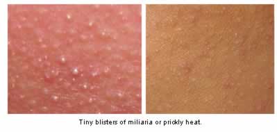 Tiny blisters of miliaria or prickly heat.