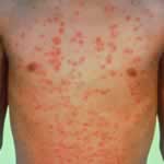 Guttate psoriasis