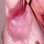 Inverse or flexural psoriasis