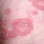 Nummular or disc-shaped psoriatic lesion