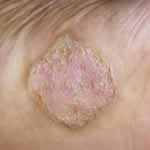 Palmoplantar psoriasis