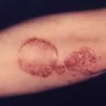 Plaque psoriasis or psoriasis vulgaris