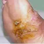 Pustular psoriasis