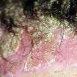Scalp or Seborrheic Psoriasis