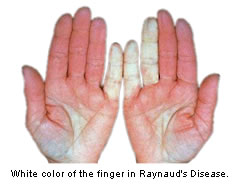 White discoloration of the fingers in Raynaud's Disease