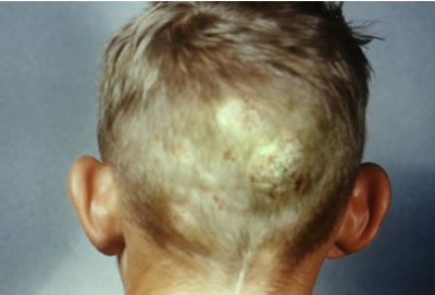 Tinea capitis or ringworm in the scalp