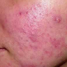 Rosacea on the face