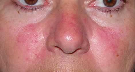 Acne rosacea