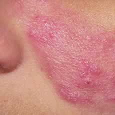 Rosacea on the cheek