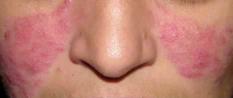 Rosacea or acne rosacea