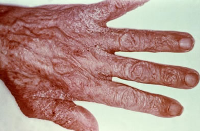 Rash due to scabies infection.