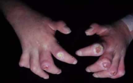 Scleroderma with ulcers