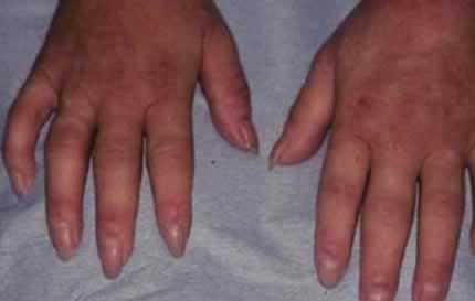 Scleroderma on the fingers