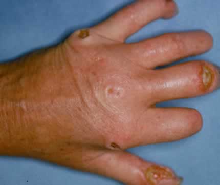 Scleroderma with ulcer on the knucles