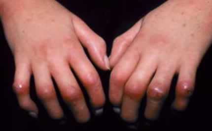 Scleroderma on the fingers.