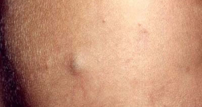 Sebaceous cyst on the cheek