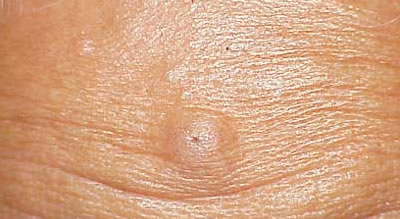 Sebaceous cyst on the forehead