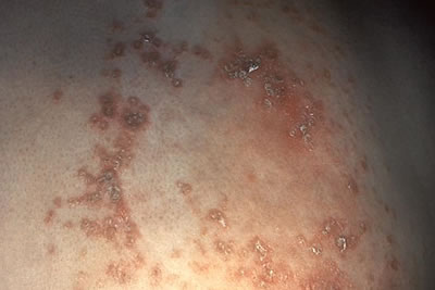 Shingles rash