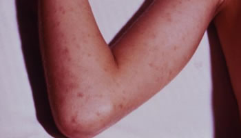 Rash caused by Rocky Mountain spotted fever