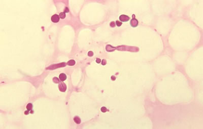 Malassezia furfur, the yeast that causes tinea versicolor
