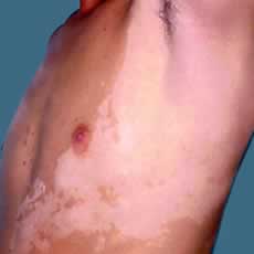 Vitiligo