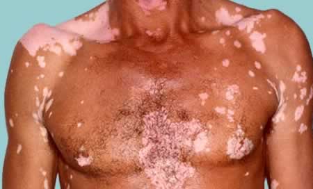 Vitiligo on the body