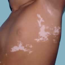 Vitiligo in children