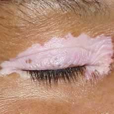 Vitiligo around the eye