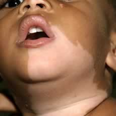 Vitiligo in infants