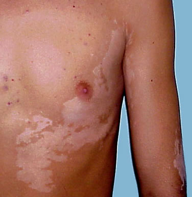 White patches of vitiligo or leukoderma.