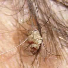 Another wart or verucca on scalp