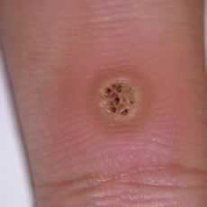 Another wart or verucca on a finger