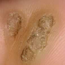Another wart or verucca on sole of foot (plantar verucca)