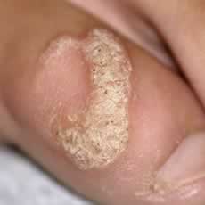 Another wart or verucca on a toe