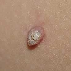 Another common wart (verucca vulgaris)