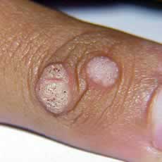 Wart on a finger