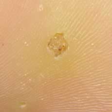 Wart on sole of foot (plantar wart)