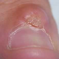 Wart on a toe