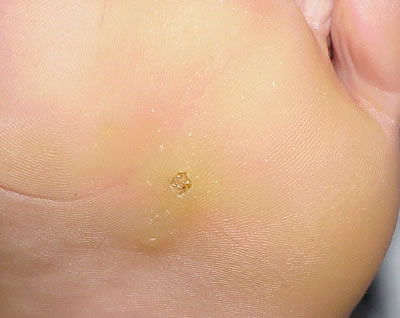 common wart images. Plantar wart, found on the